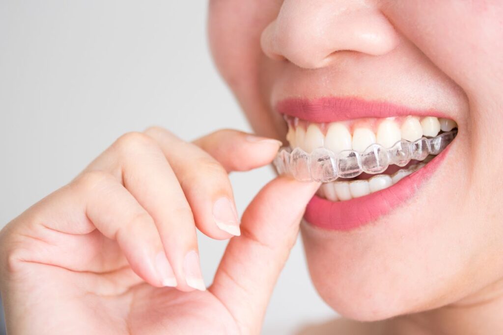 A woman putting in an invisalign aligner.