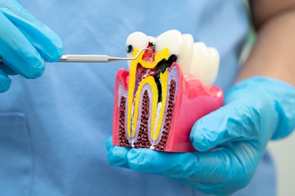 What You Should Know About The Failure Rate Of Root Canals